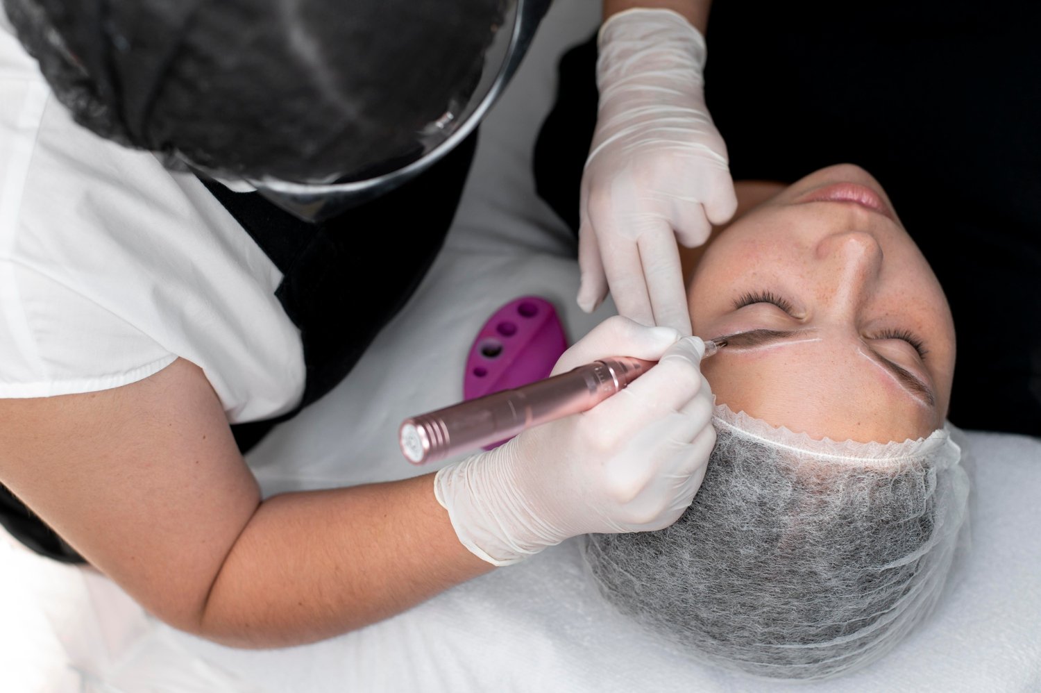 Microneedling with Growth Factors